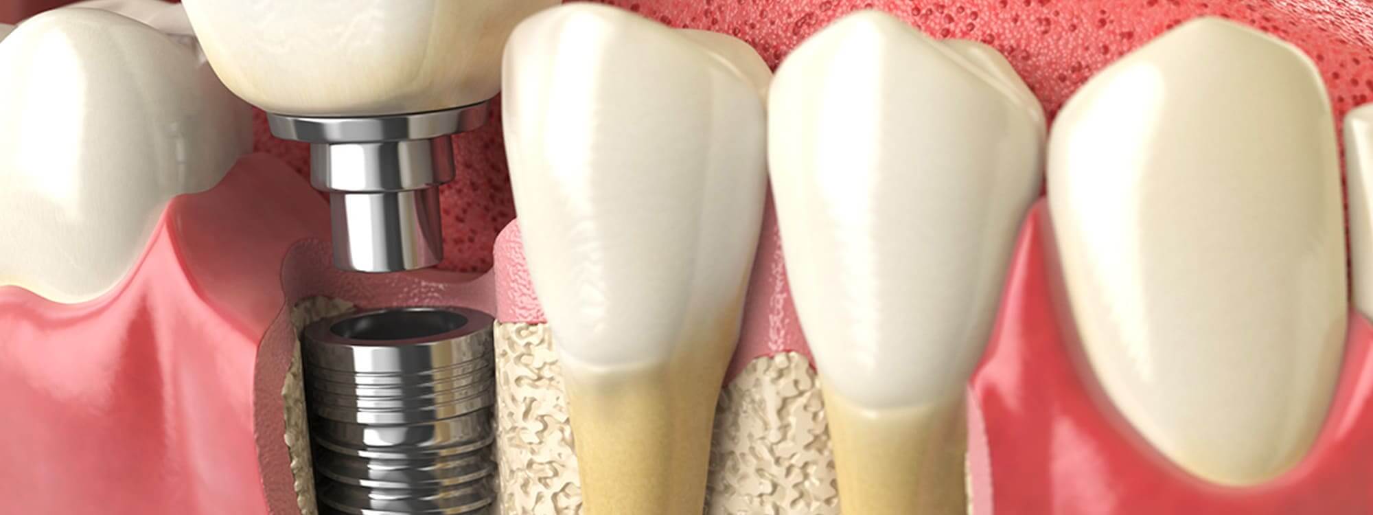 Implants dentaires à Dijon